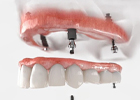 微创种植牙